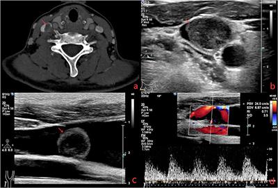 Intravascular Fasciitis of the Jugular Vein Mimicking Thrombosis and Sarcoma: A Case Report